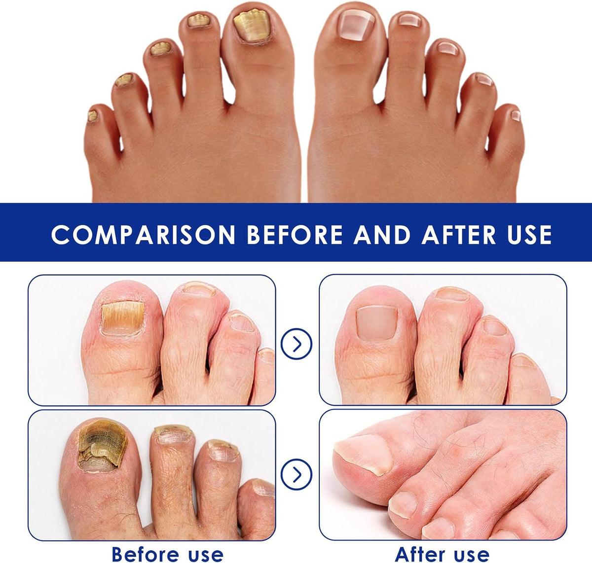 30Ml Nail Treatment,Nail Fungus Treatment for Toenail & Fingernails, Protects Thick, Broken and Discolored Nails